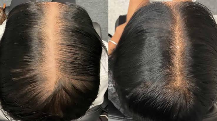 Anti Aging Treatment Before and After